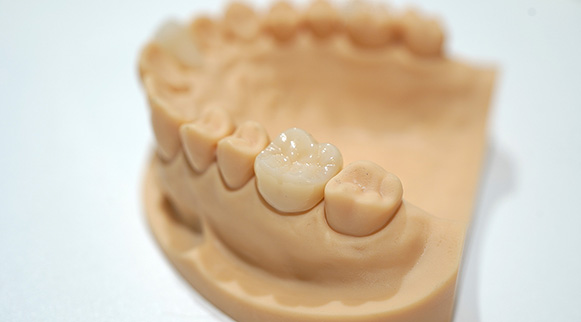 オールセラミック（プロセラ）