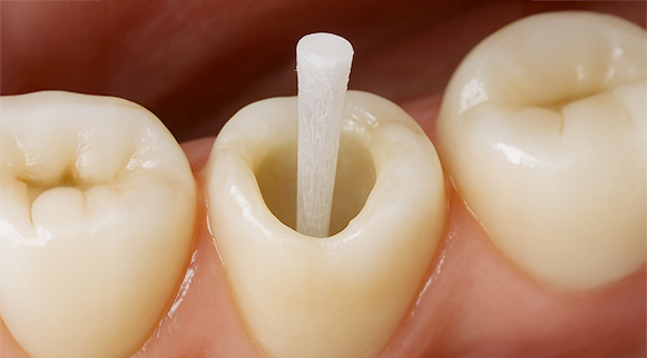 ファイバーコア