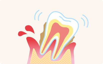 歯ぐきが腫れてるイメージ図