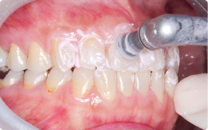 PMTCしているところ