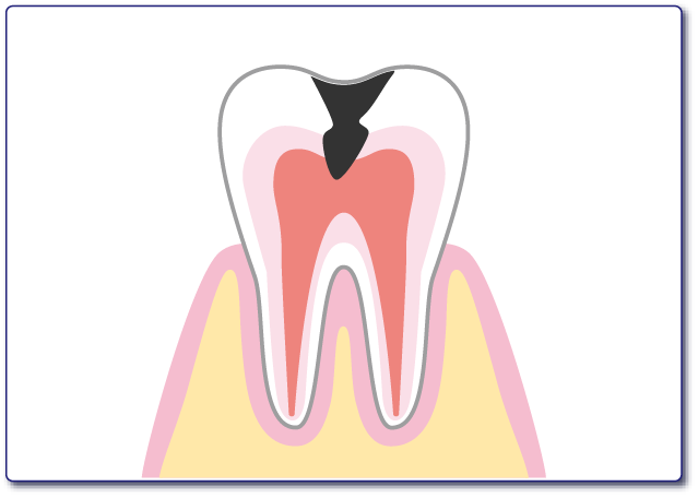 進行した虫歯の図
