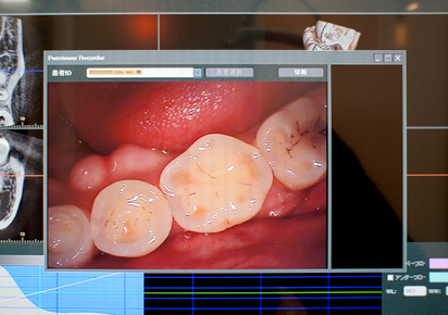 口腔内カメラ