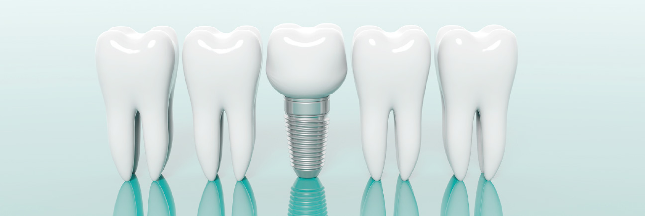 インプラントの画像