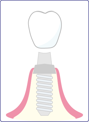 上部構造 取付のイラスト