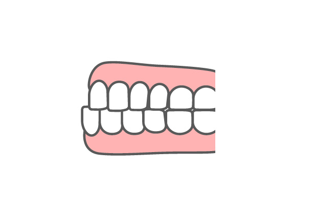 反対咬合（下顎前突）