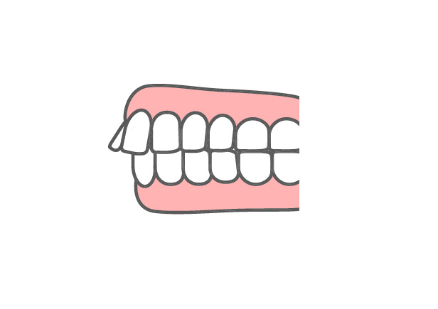 出っ歯（上顎前突）