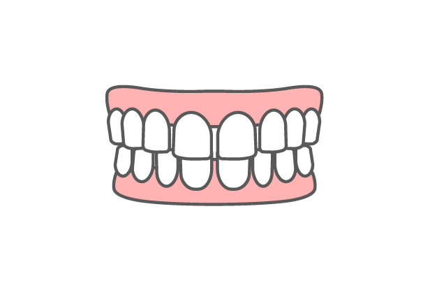 すきっ歯（正中離開）