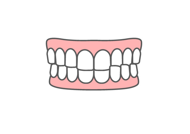 交叉咬合（こうさこうごう）