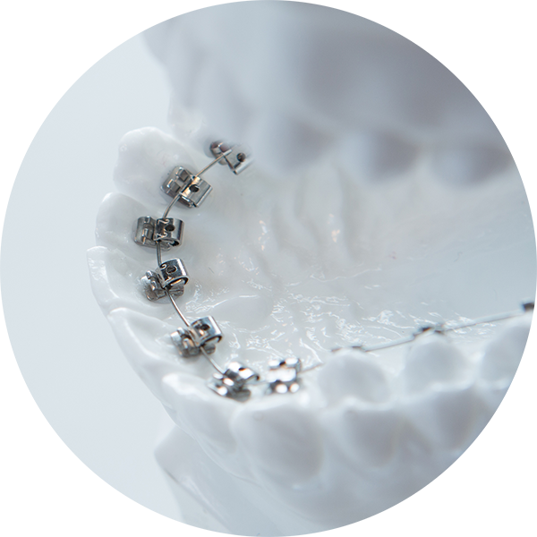 裏側矯正の写真