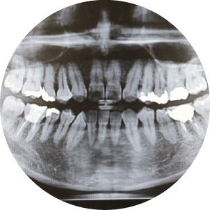 レントゲン写真