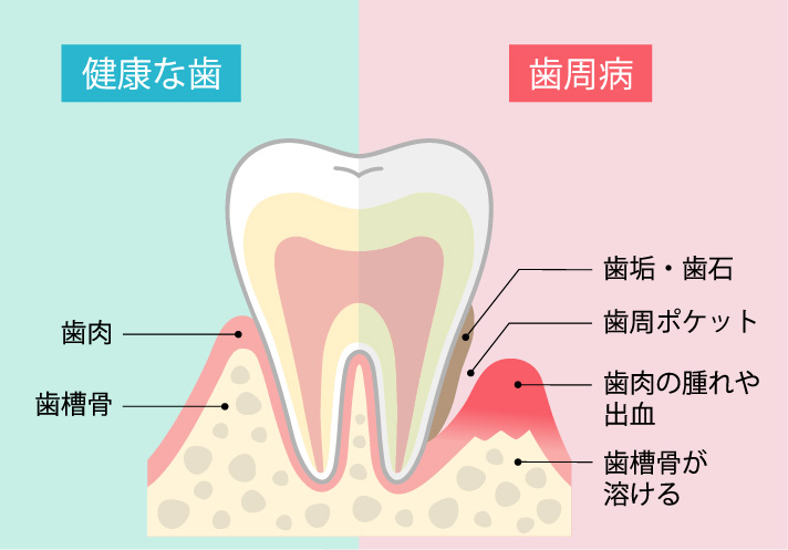 健康な歯と歯周病の歯の断面図