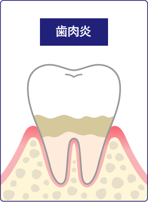 歯肉炎の画像
