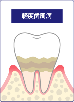 軽度歯周病の画像