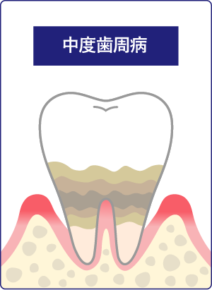中度歯周病の画像