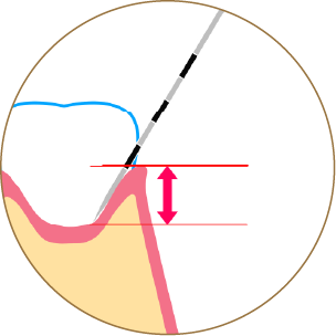 歯周ポケットの画像