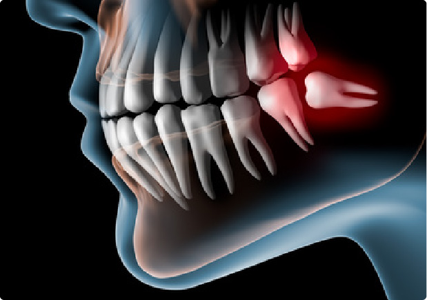 親知らずイメージ