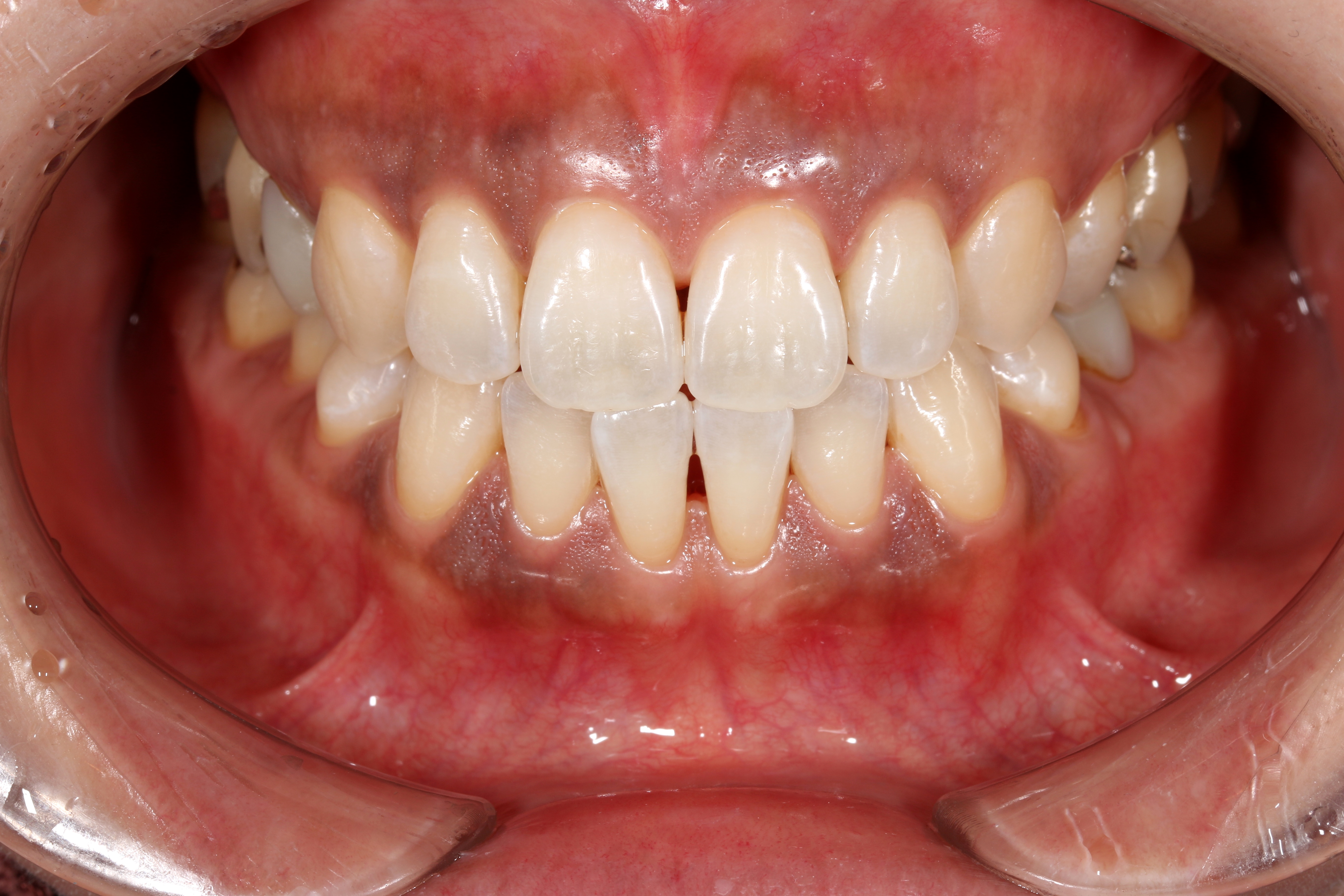 オフィスホワイトニングafter