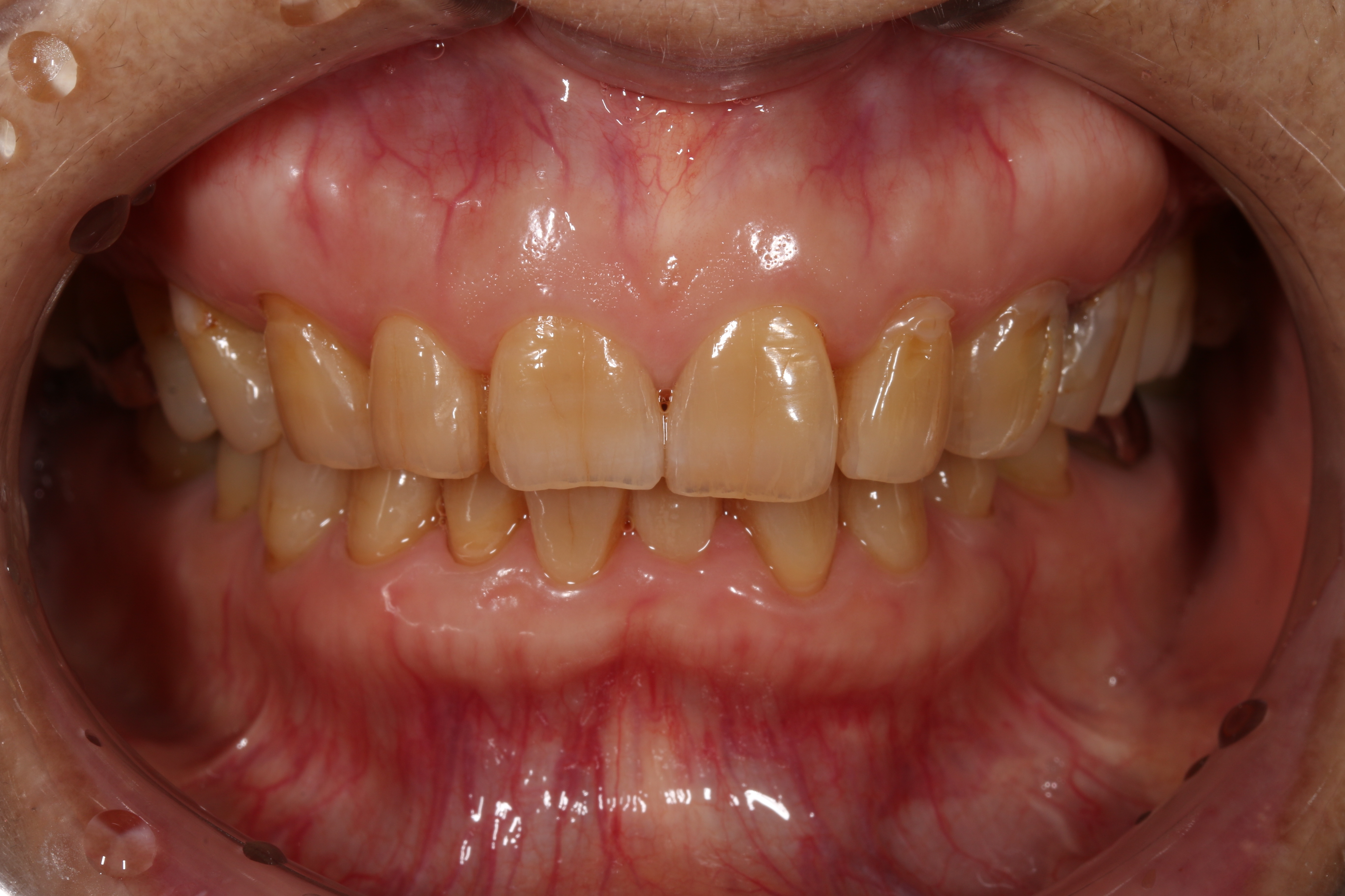 ホームホワイトニングbefore