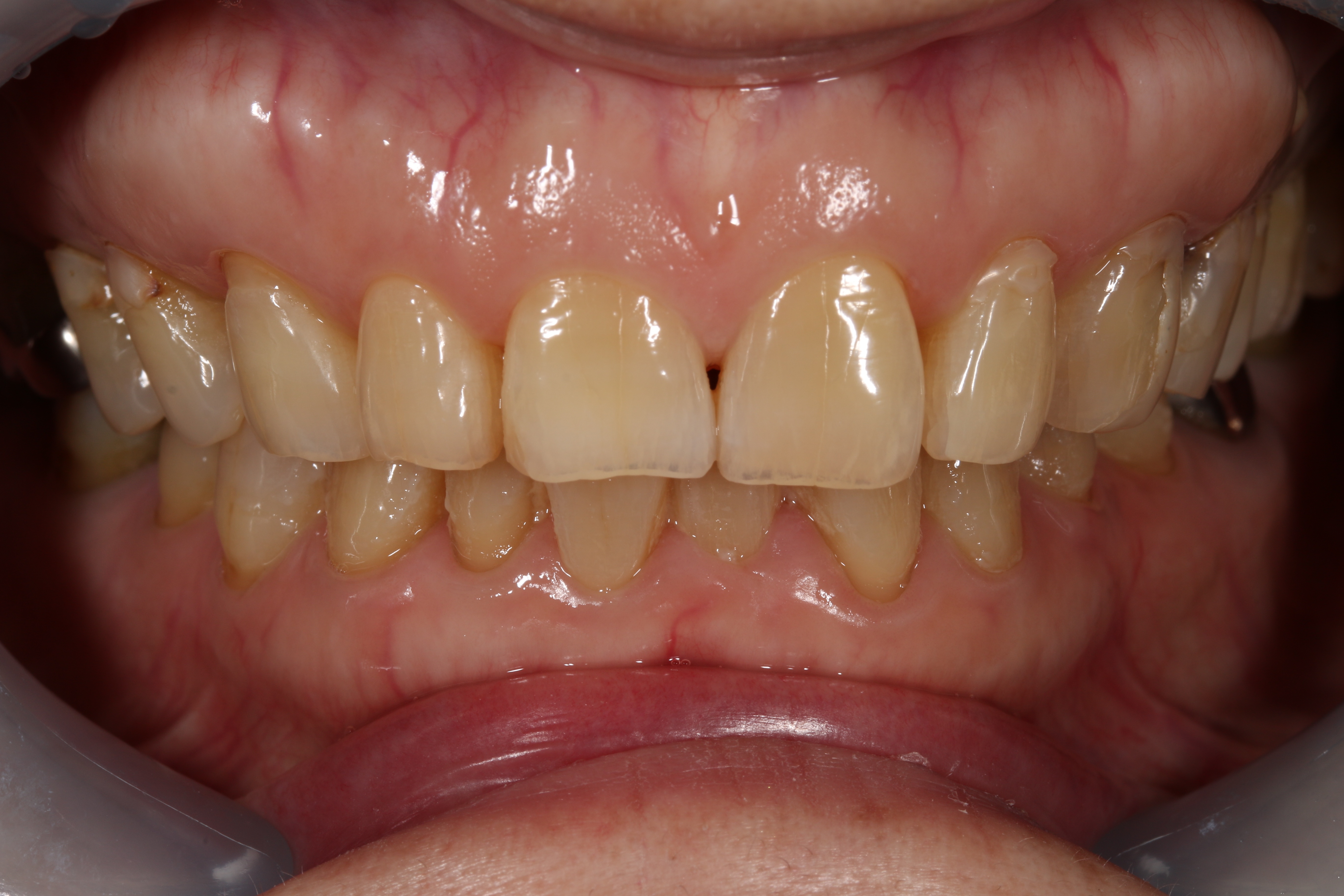 ホームホワイトニングafter