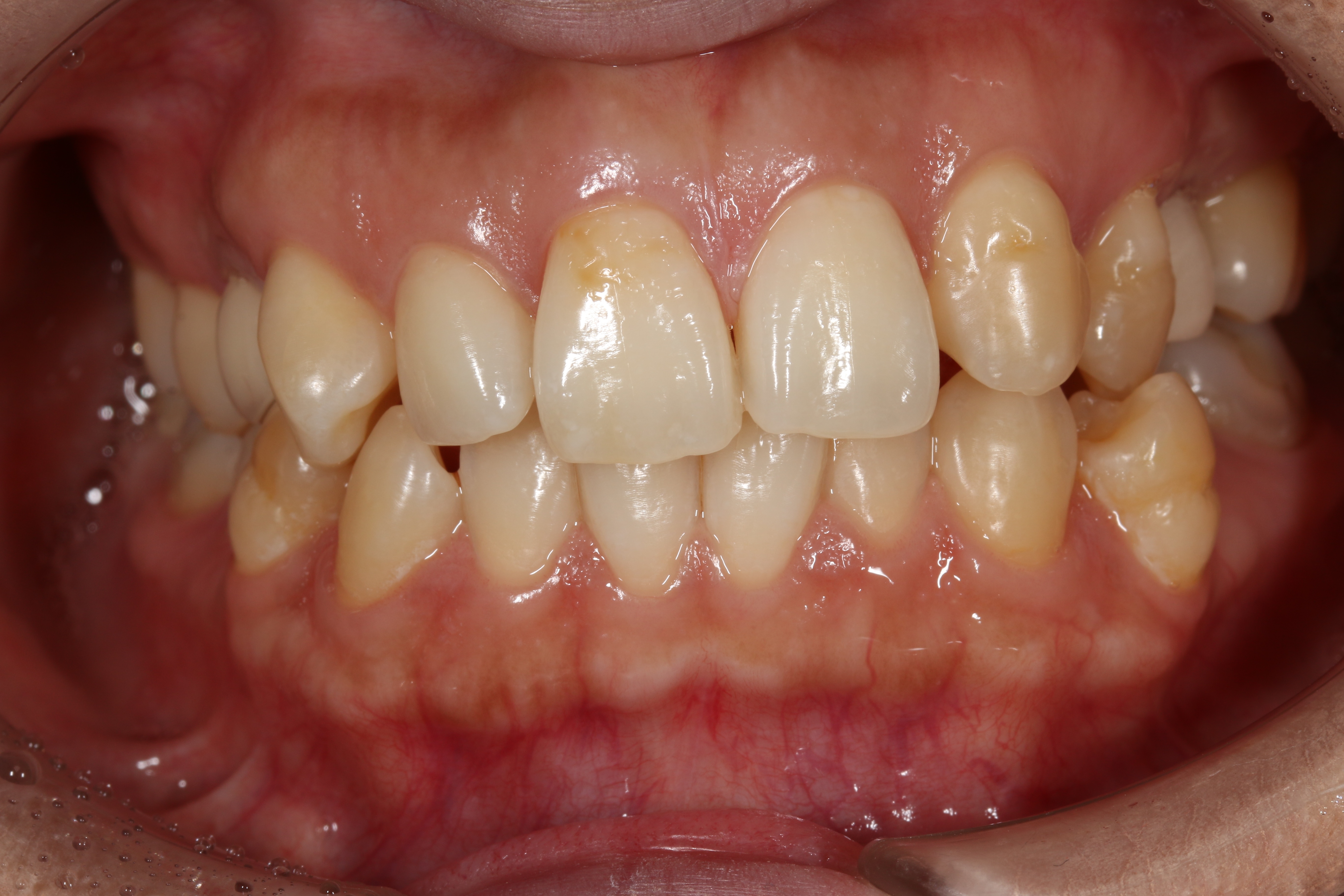 デュアルホワイトニングbefore