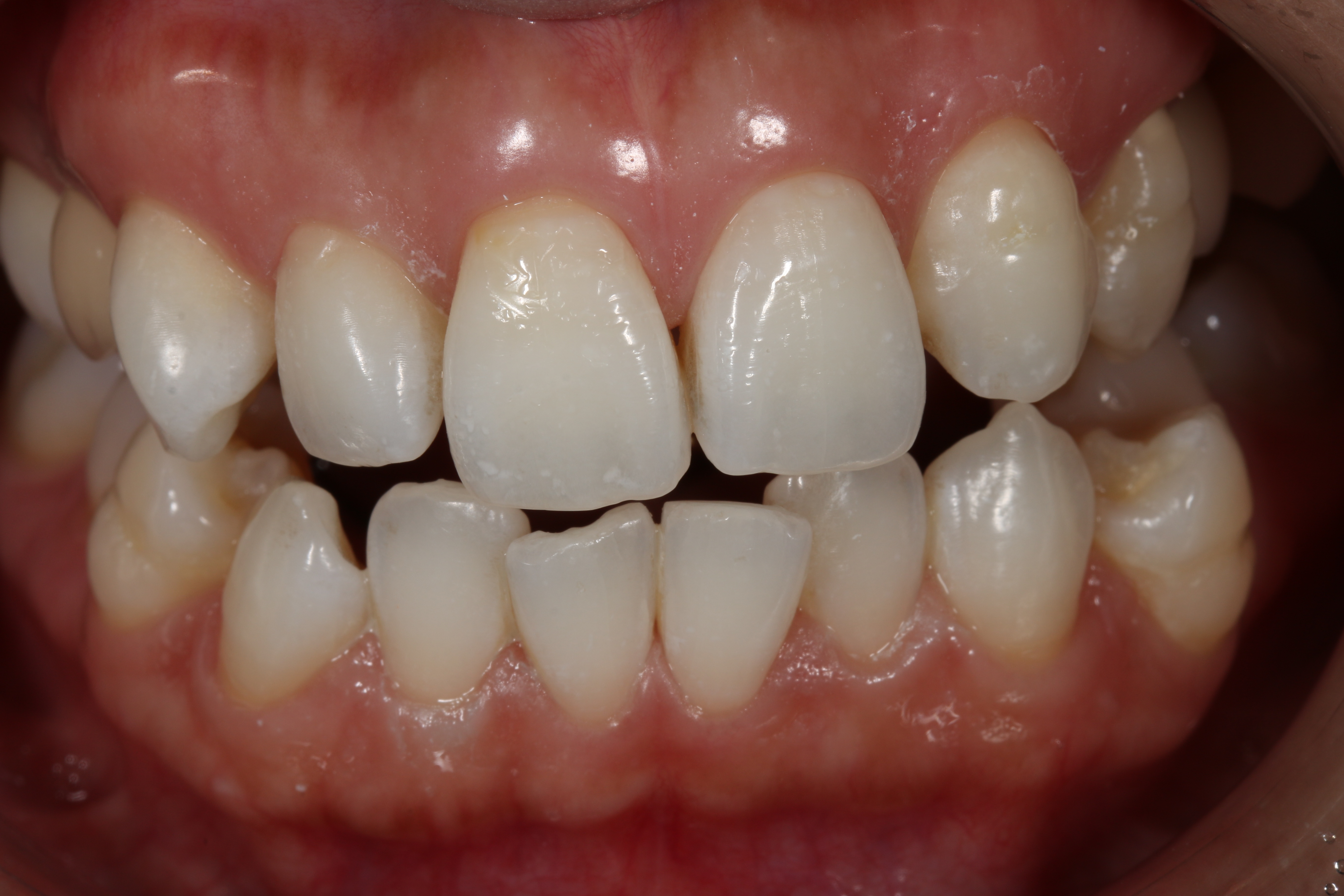 デュアルホワイトニングafter