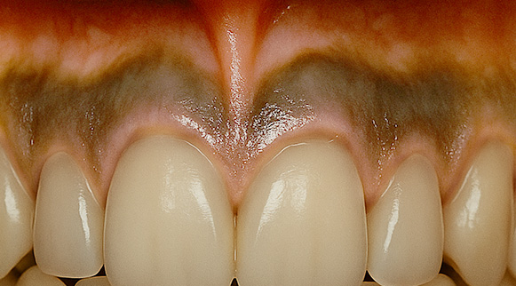 ガムピーリングbefore