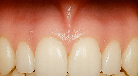 ガムピーリングafter